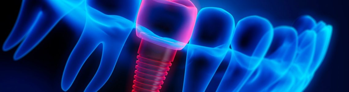 dental-crowns-technology