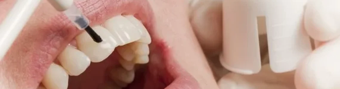 fluorizare-dentara.jpeg