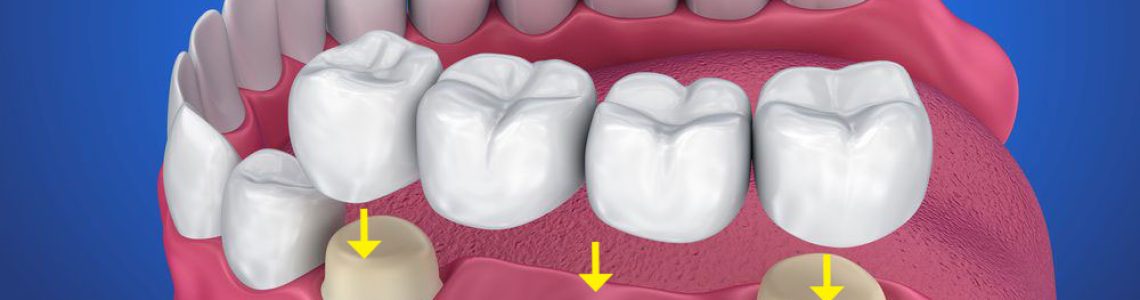 punte-dentara-coroane-dentare